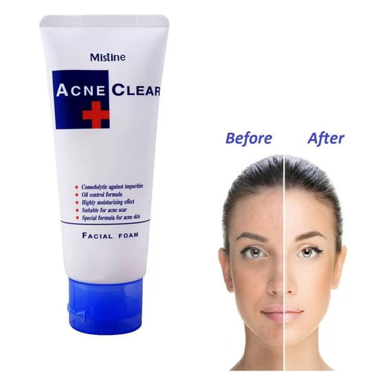 Acne Control Face Wash